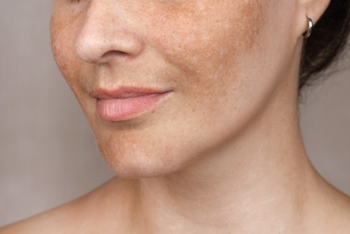 Close,Up,Caucasian,Woman's,Face,With,Freckles,Or,Age,Spots, 1767891833 e1c58bc52d3a4880b15ccd4f4d4f3292 1 1