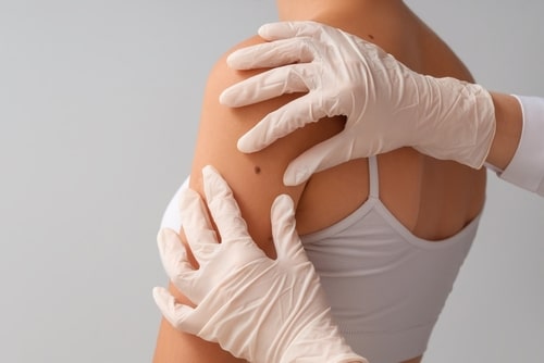 Dermatologist,Examining,Young,Woman's,Mole,On,Light,Background,,Closeup 1767891873 2753dad0f52b49b29f84758e474ffb60 1 1